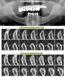 Left Posterior Mandible Before and After Split